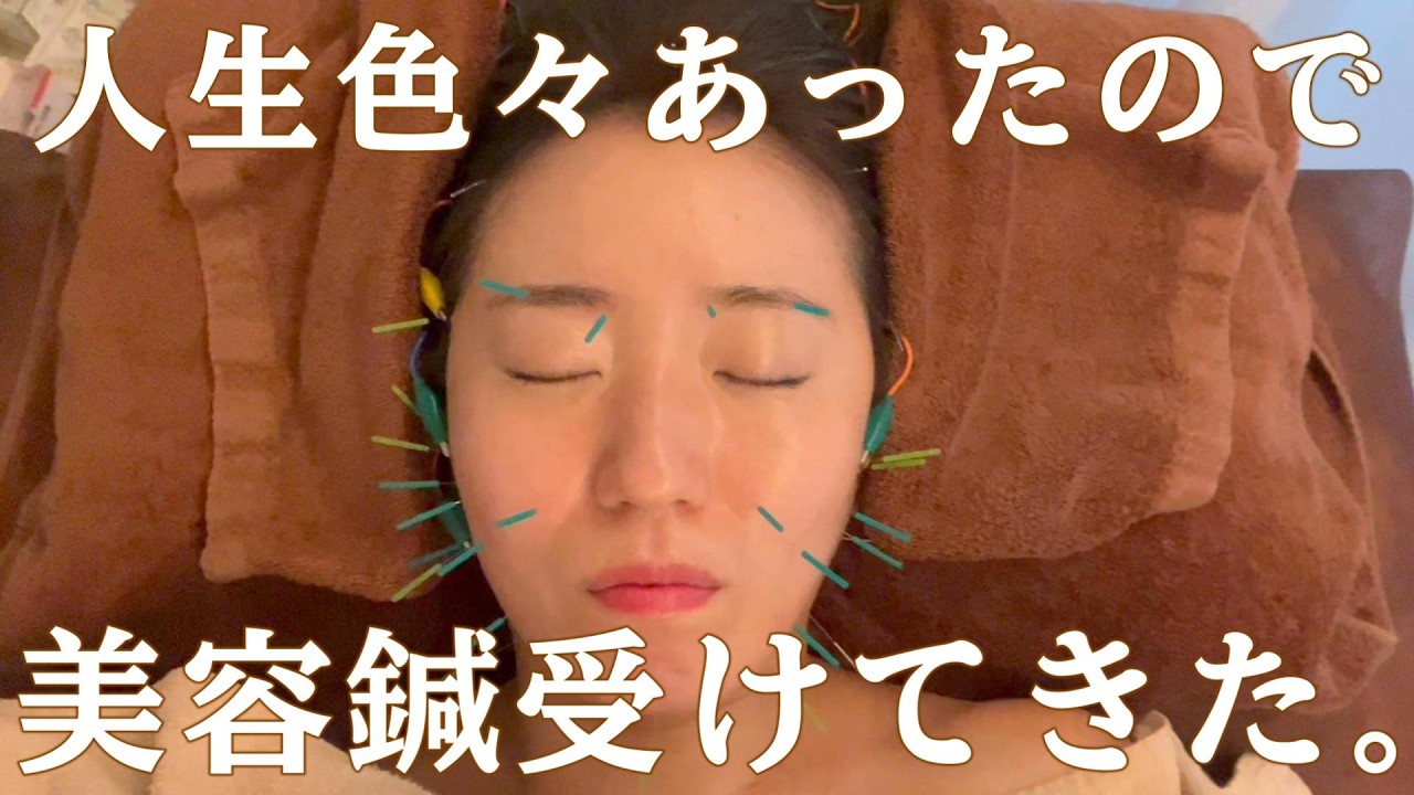 【Vlog】30代、人生で大きい決断したら顔むくんだので美容鍼受けてきた🥰
