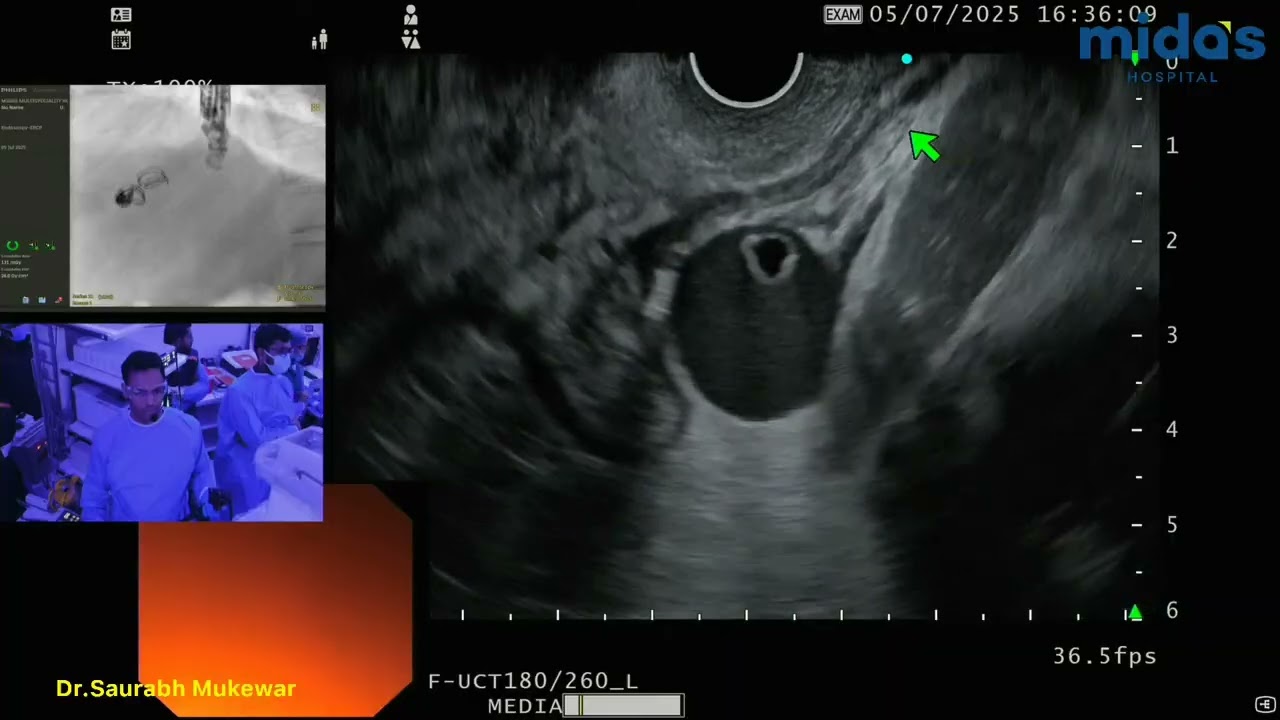 Live EUS guided Porto-Systemic Shunt and Gastric Varices Coiling and Glue Injection By Dr. Saurabh