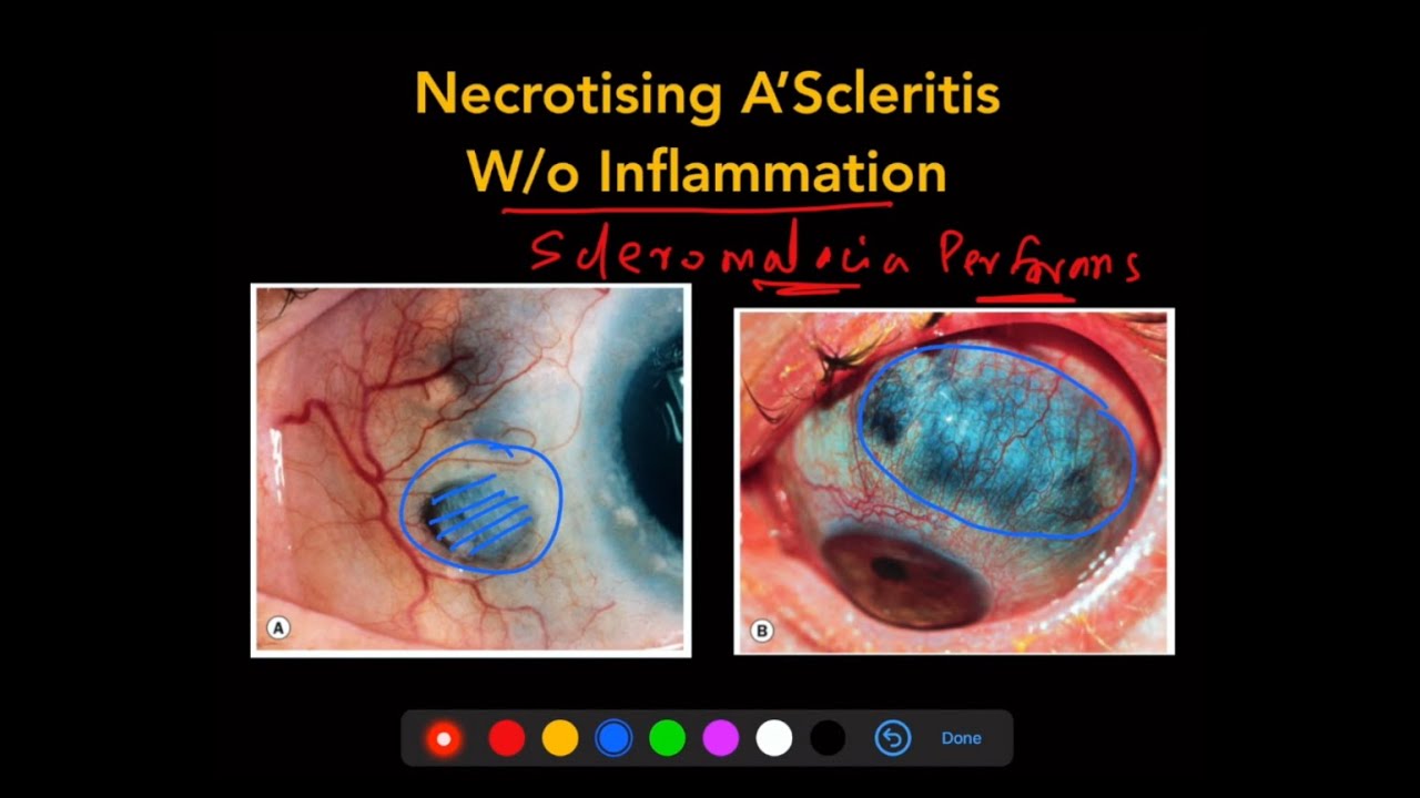 Scleritis - The Complete Course