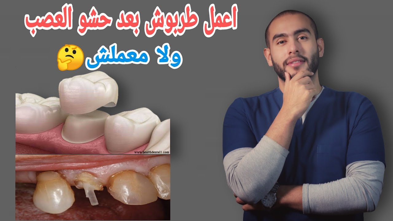اهميه تركيب الطربوش أو التلبيسه بعد حشو العصب | هل الطربوش مهم بعد حشو العصب | كيفيه تركيب الطربوش