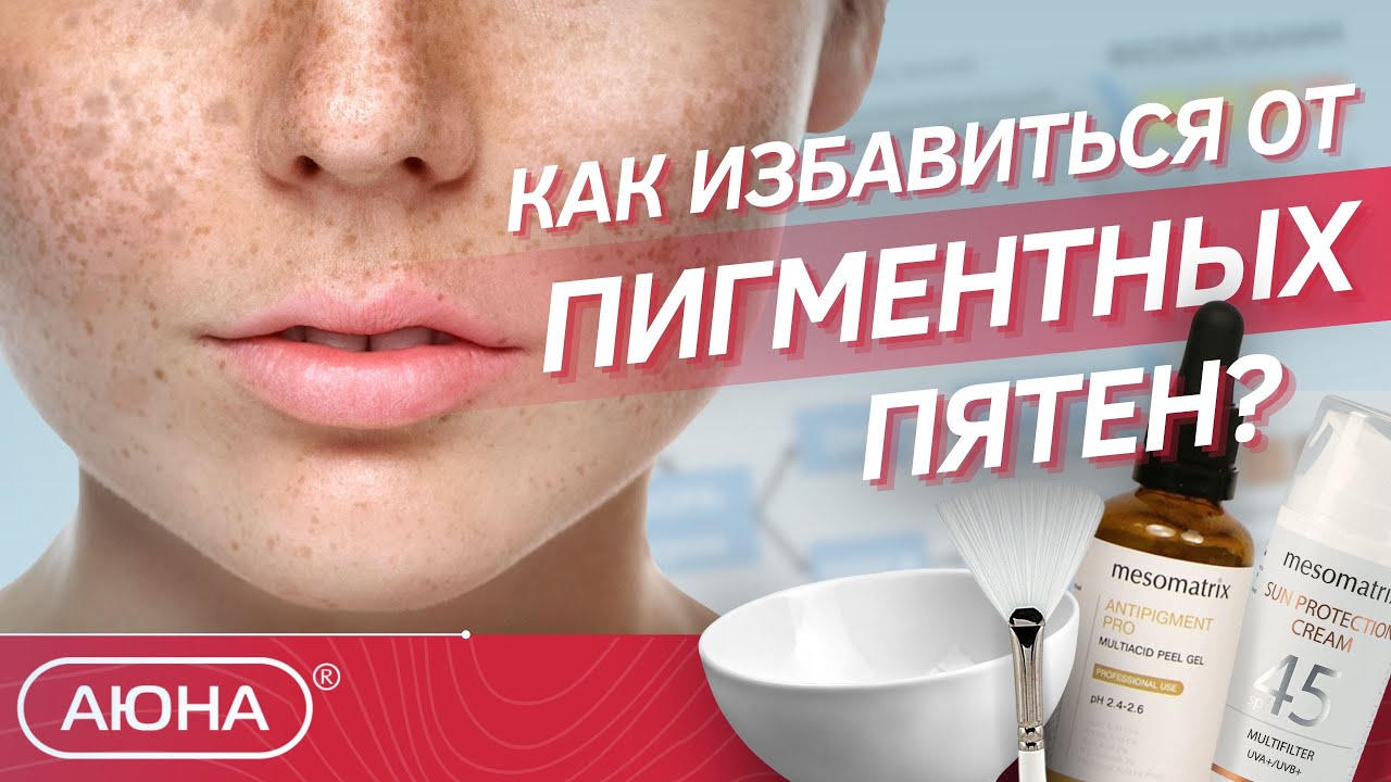 Пигментные пятна | Причины появления и методы борьбы | Домашний и профессиональный уход