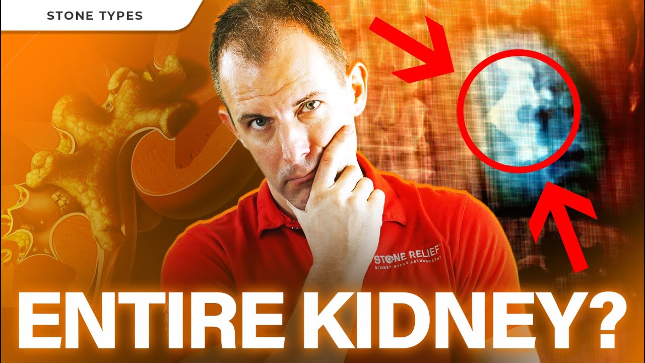 Staghorn Kidney Stones: Causes, Treatments, Prevention, and Diet Tips