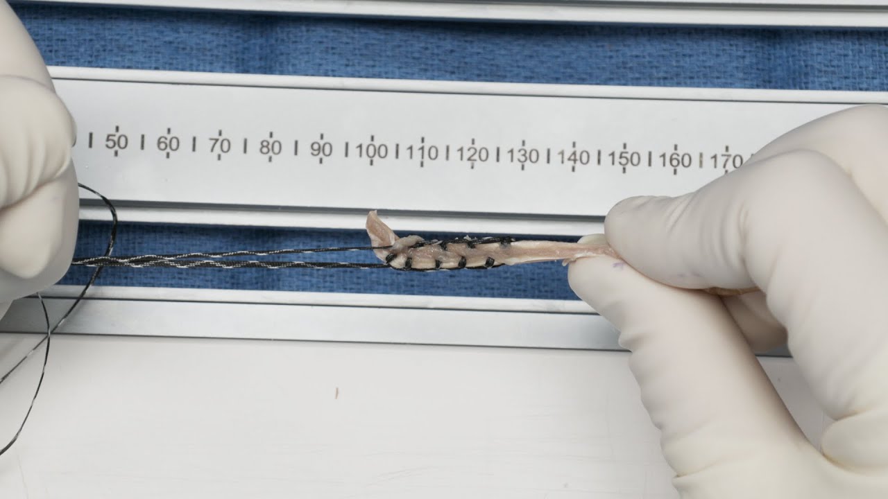 Soft-Tissue Graft Suturing With SutureTape: Technique and Pearls