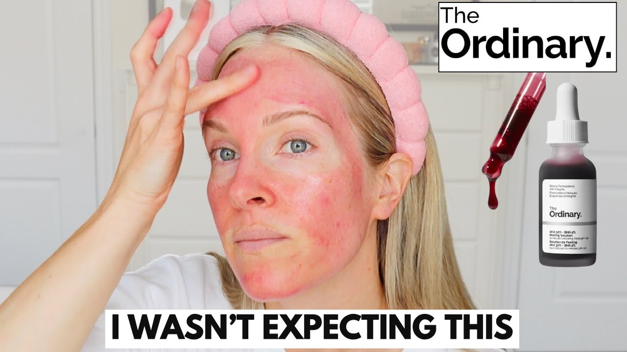 TRYING THE ORDINARY PEELING SOLUTION FOR THE FIRST TIME IN 6 YEARS | DEMO + SKINCARE ROUTINE!