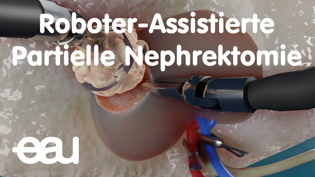 Robot-assisted partial nephrectomy