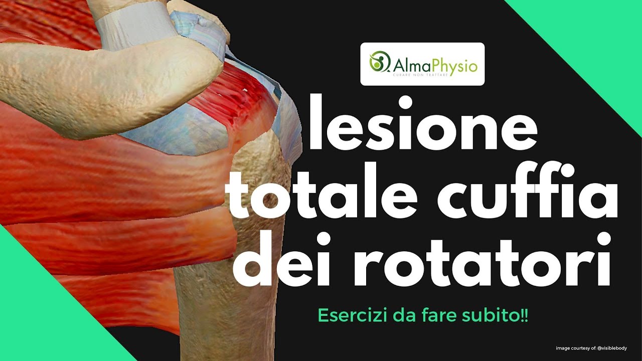 lesione Totale cuffia dei rotatori: esercizi (da fare subito!!!)