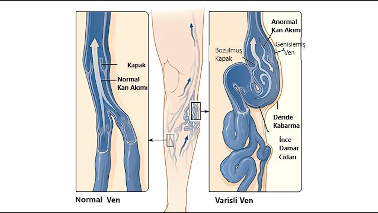 Varis nedir? - Do&ccedil;. Dr. Oğuz Yılmaz (Kalp ve Damar Cerrahisi Uz.)