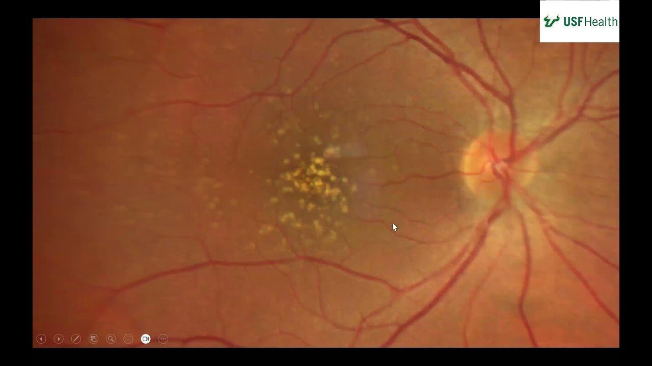Macular Drusen in a  54 year old   Thomas King - 2025 02 14