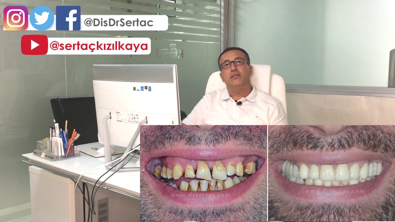 Zirkonyum diş kaplama zararlı mı? Diş Hekimi Sertaç Kızılkaya İstanbul Diş estetiği ve implant