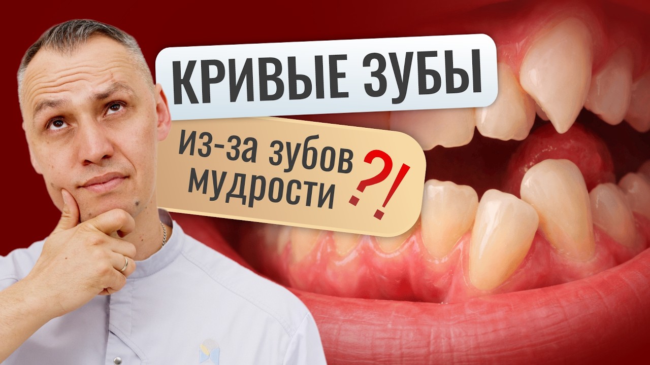 СКУЧЕННОСТЬ ЗУБОВ ИЗ ЗА 8-ОК