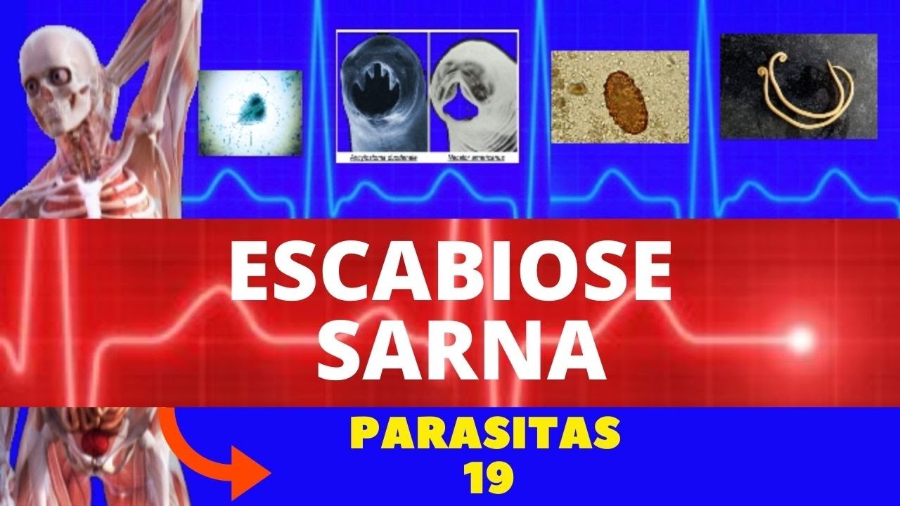 ESCABIOSE - SARNA HUMANA (SARCOPTES SCABIEI HOMINIS) - PARASITOLOGIA | INFECTOLOGIA