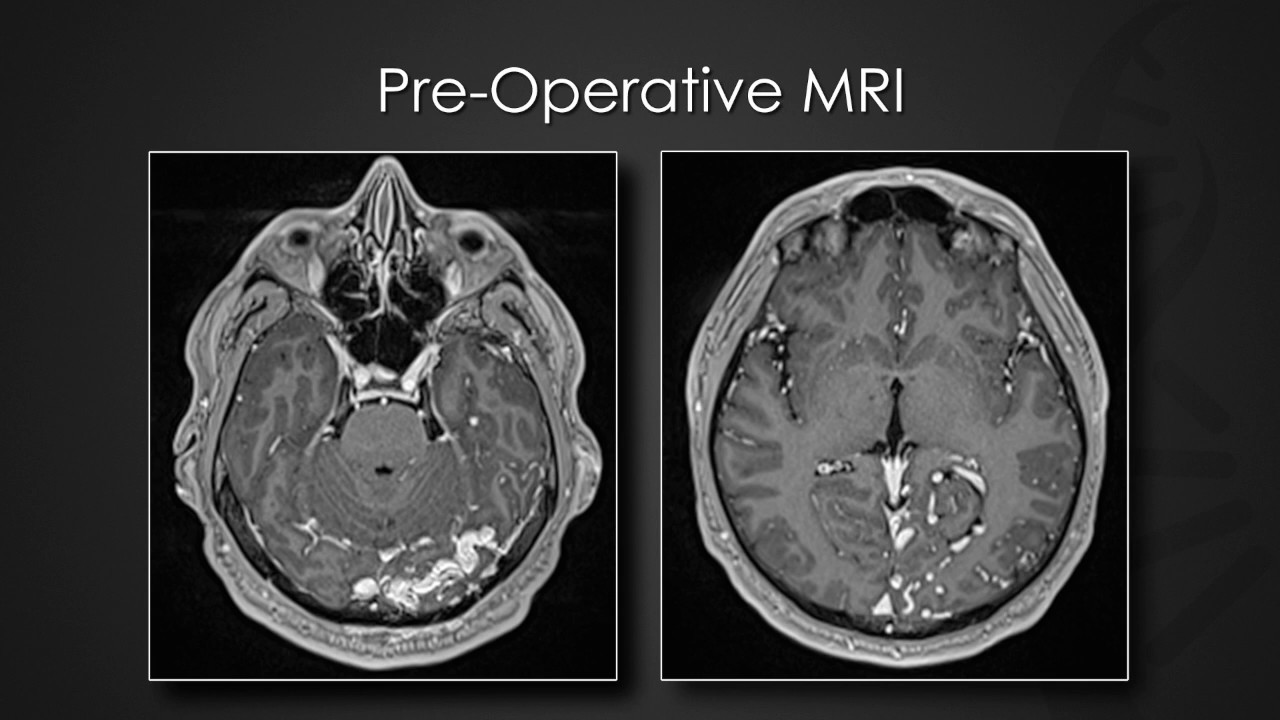 Staged transarterial endovascular embolization of malignant dAVF using Onyx & n-butyl cyanoacrylate