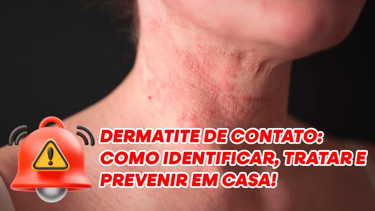Dermatite de Contato: Como Identificar, Tratar e Prevenir em Casa! - Dr. William Santussi