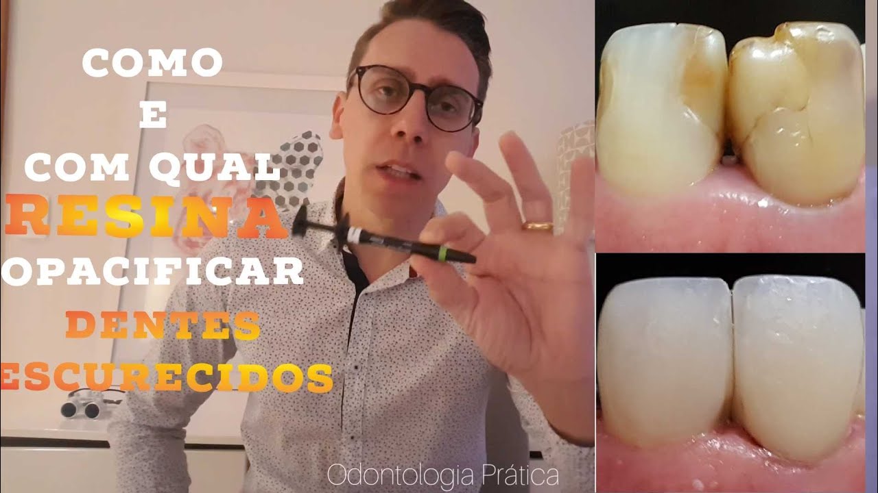 🛑✍COMO OPACIFICAR DENTES ESCURECIDOS 🤫✍RESINAS E PIGMENTOS INDICADOS NA PRÁTICA ✔
