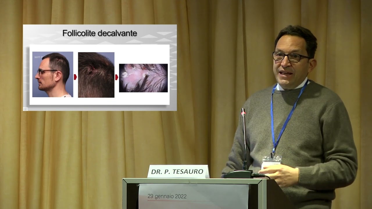 Caso Clinico N°9 Dr. Piero Tesauro -20 CASI CLINICI IN TRICOLOGIA 2022