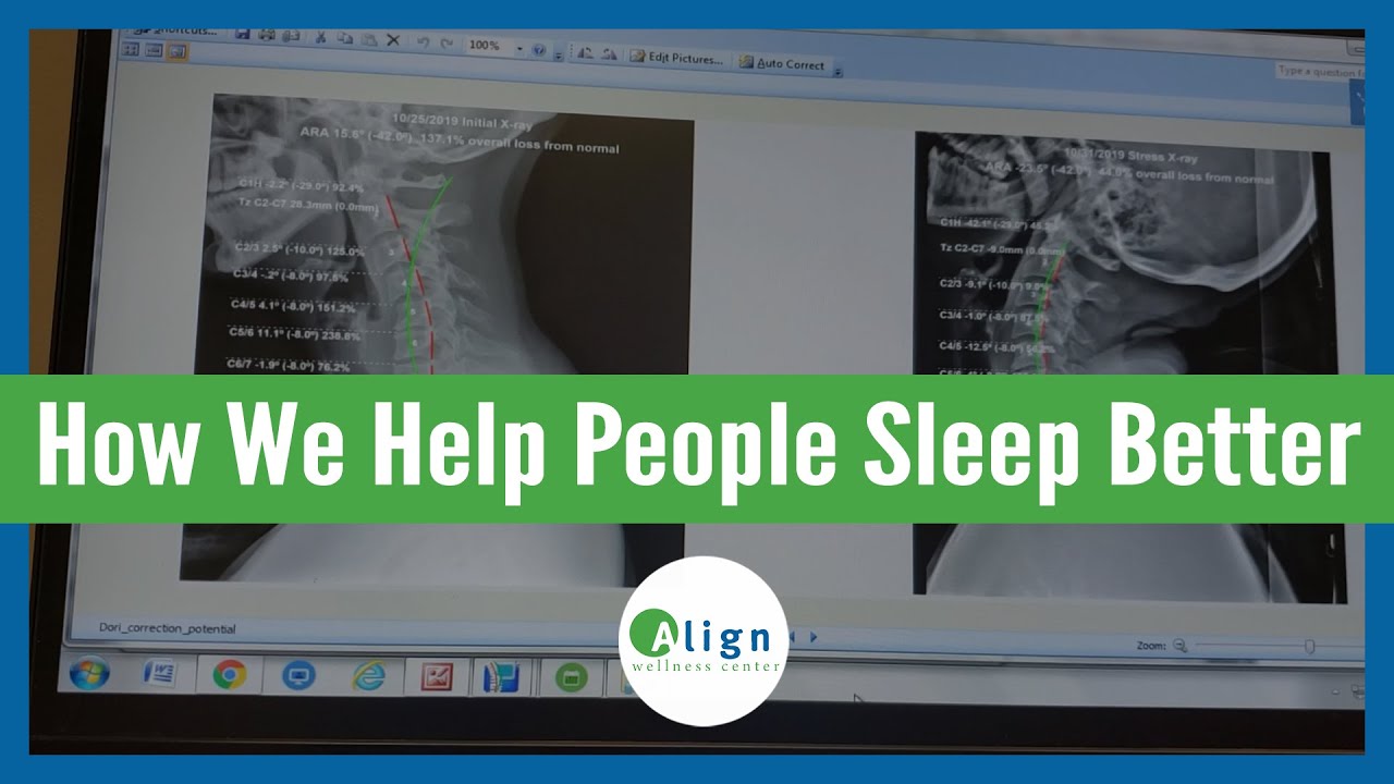A Case Study on Sleep and the Spinal Cervical Curve