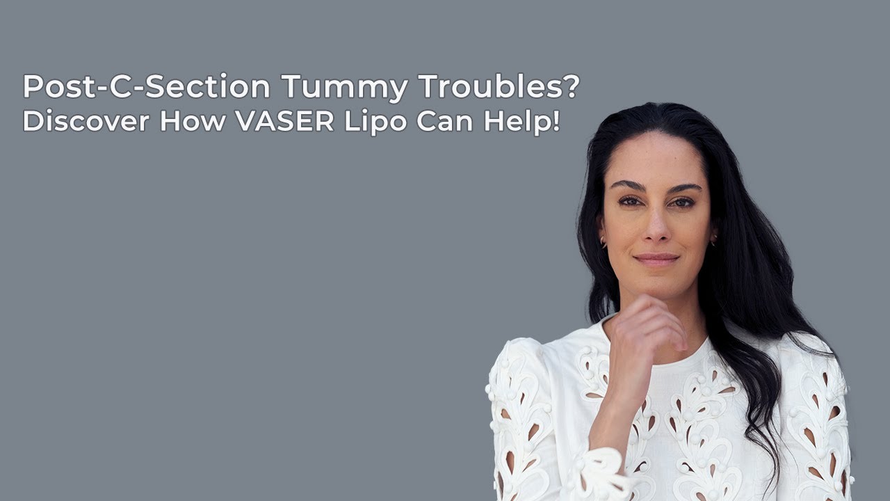 Post-C-Section Tummy Troubles? Discover How VASER Lipo Can Help!