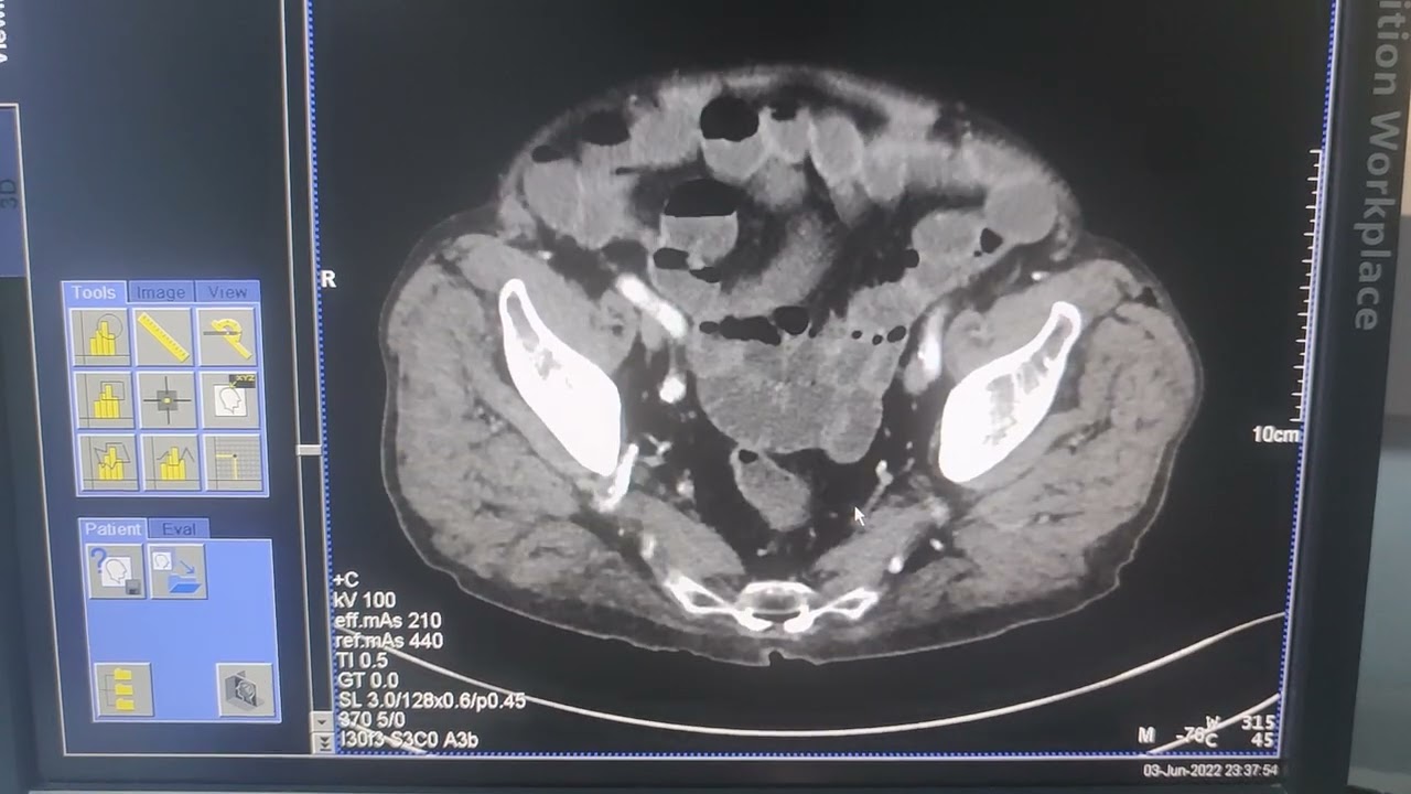 Abdomen Tomografi Radyolijik Anatomi İlaçlı Abdomen Tomogrofi görüntüsü