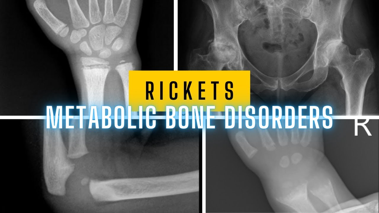 Rickets and Metabolic Bone Disorders