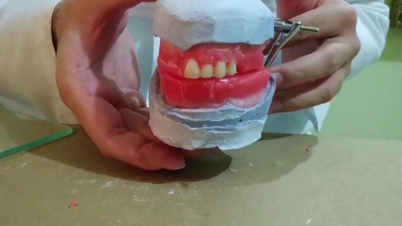 Enfilado de dientes artificiales en prótesis total (1/2)