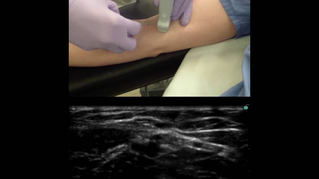 Ultrasound-Guided IV Insertion: Dynamic Needle Tip Tracking