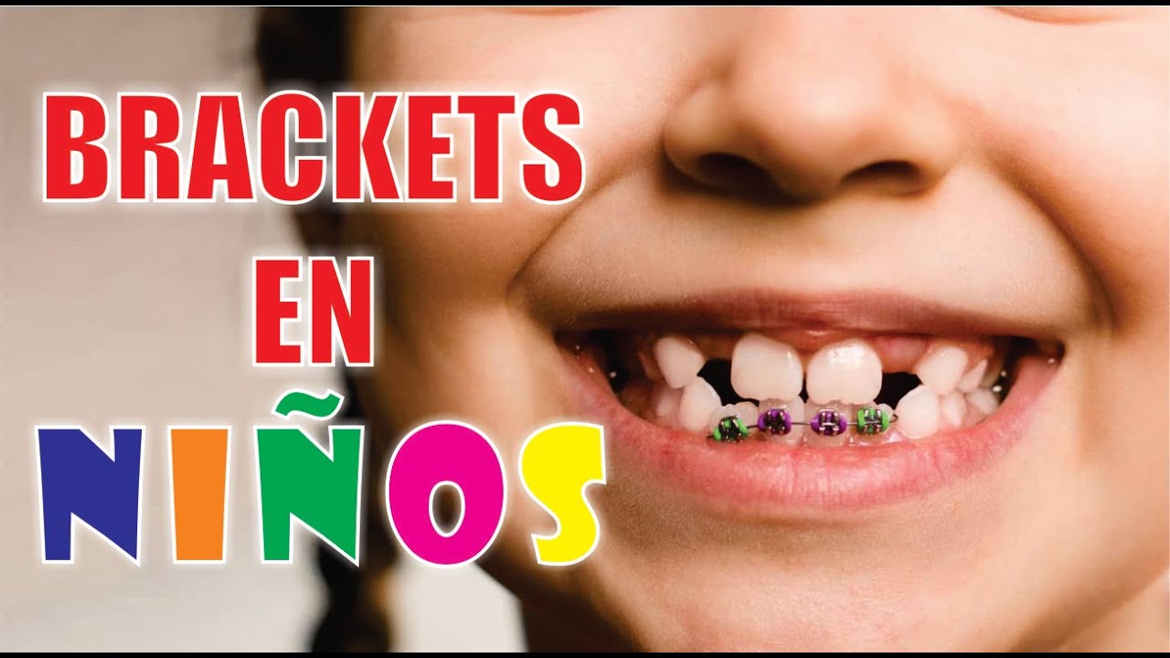 ¿BRACKETS para NIÑOS? 🦷 ORTODONCIA en la PRIMERA INFANCIA 👶 SANTIAGO BURGA 3D digital dental design