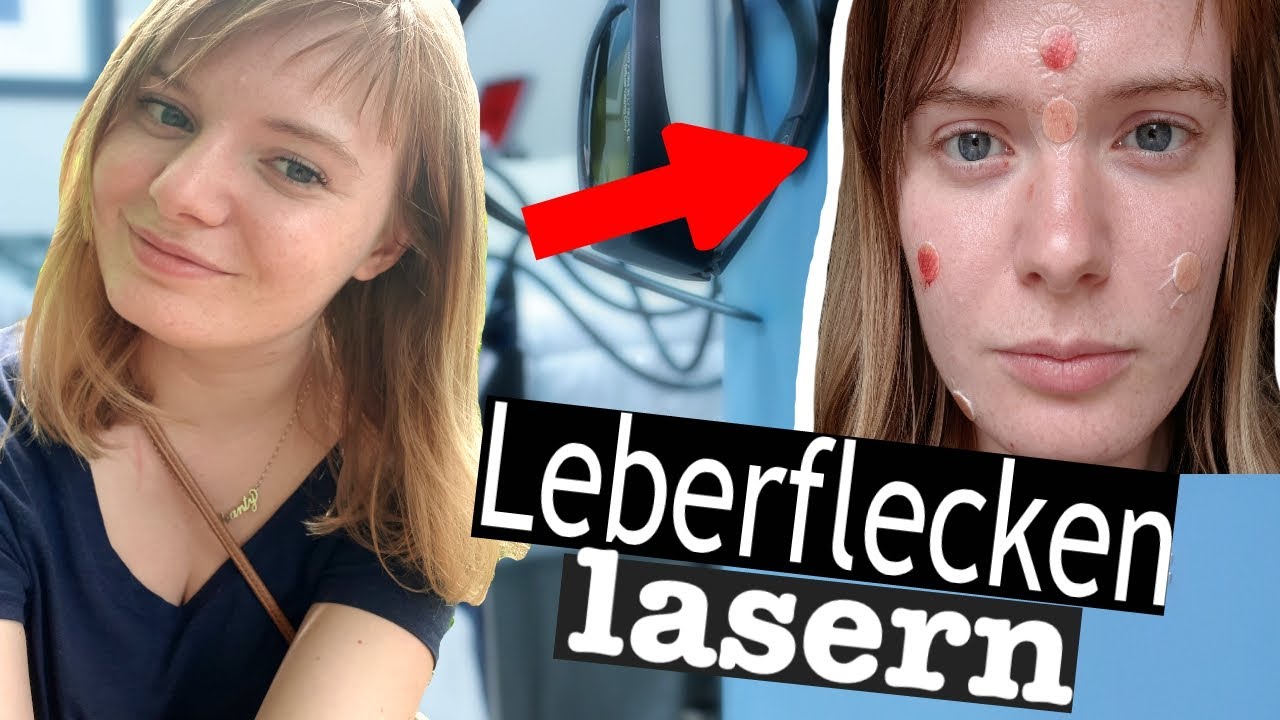 Schönheits-OP mit 23? | Muttermale im Gesicht weglasern I Vorher/Nachher Bilder & Timestamps!)