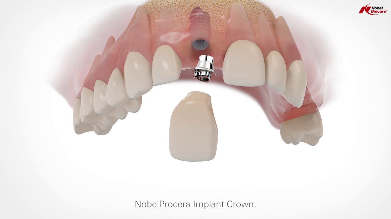 NobelProcera Restorations in multilayered zirconia