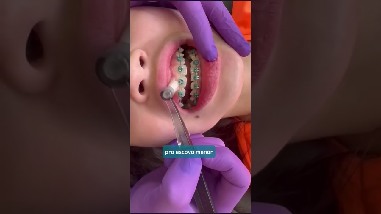 Como escovar os dentes com aparelho fixo