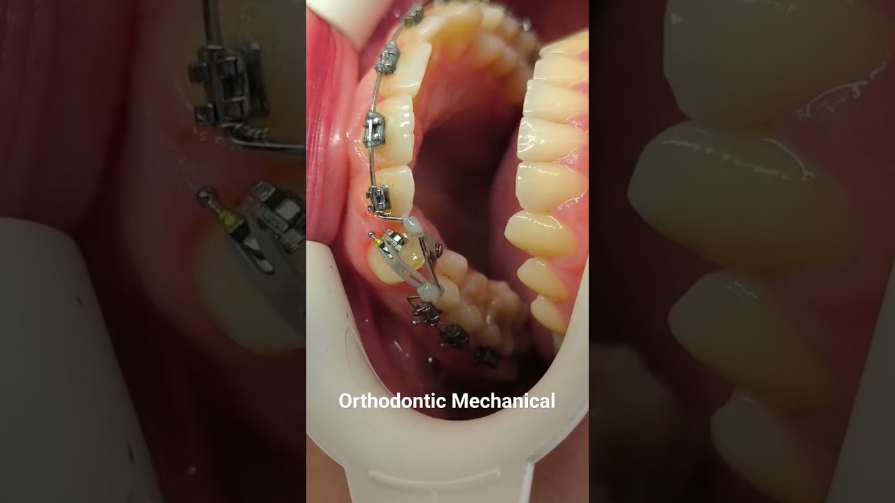 Ortodontik Mekanik#ortodonti #dentist#implant  #ortodontist #teli#smile #beyazlatma #estetik
