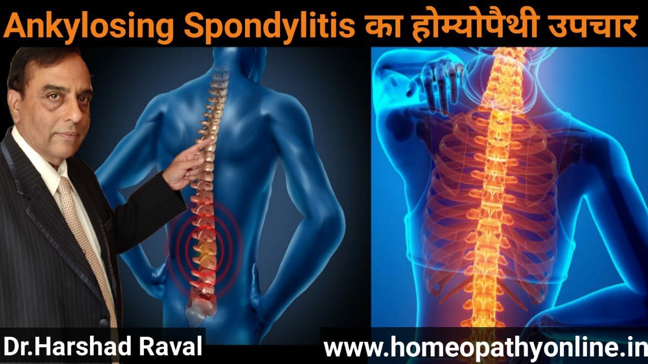 Homeopathic treatment for Ankylosing Spondylitis l AS treatment l hla b27 positive
