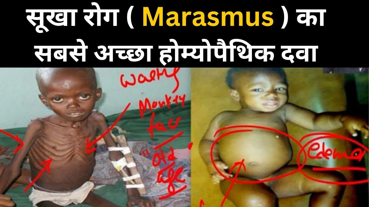 सूखा रोग ( Marasmus ) का सबसे अच्छा होम्योपैथिक दवा #drgpsingh
