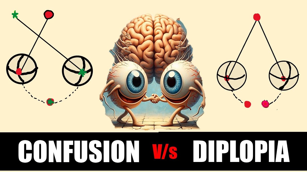 Binocular single Vision | Sensory Adaptations| Confusions, Diplopia, suppression and ARC