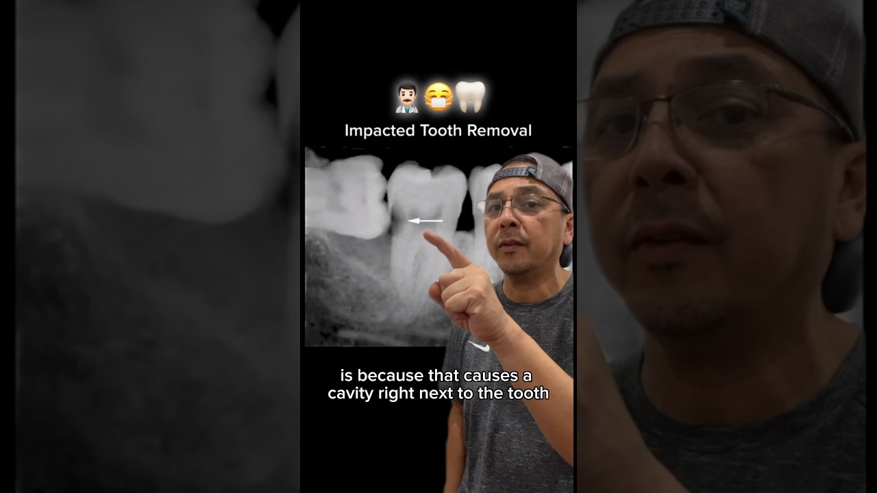 How Removing IMPACTED Wisdom Tooth will PREVENT Futute Dental Problems | View Mobile Dental 