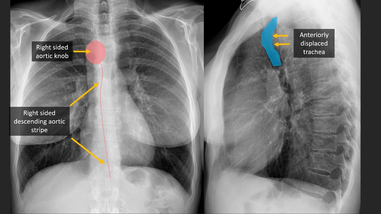 Cardiovascular Findings on Chest Radiography with CT and MRI correlation
