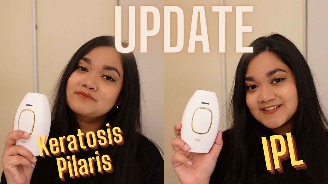 How to treat Keratosis Pilaris with IPL