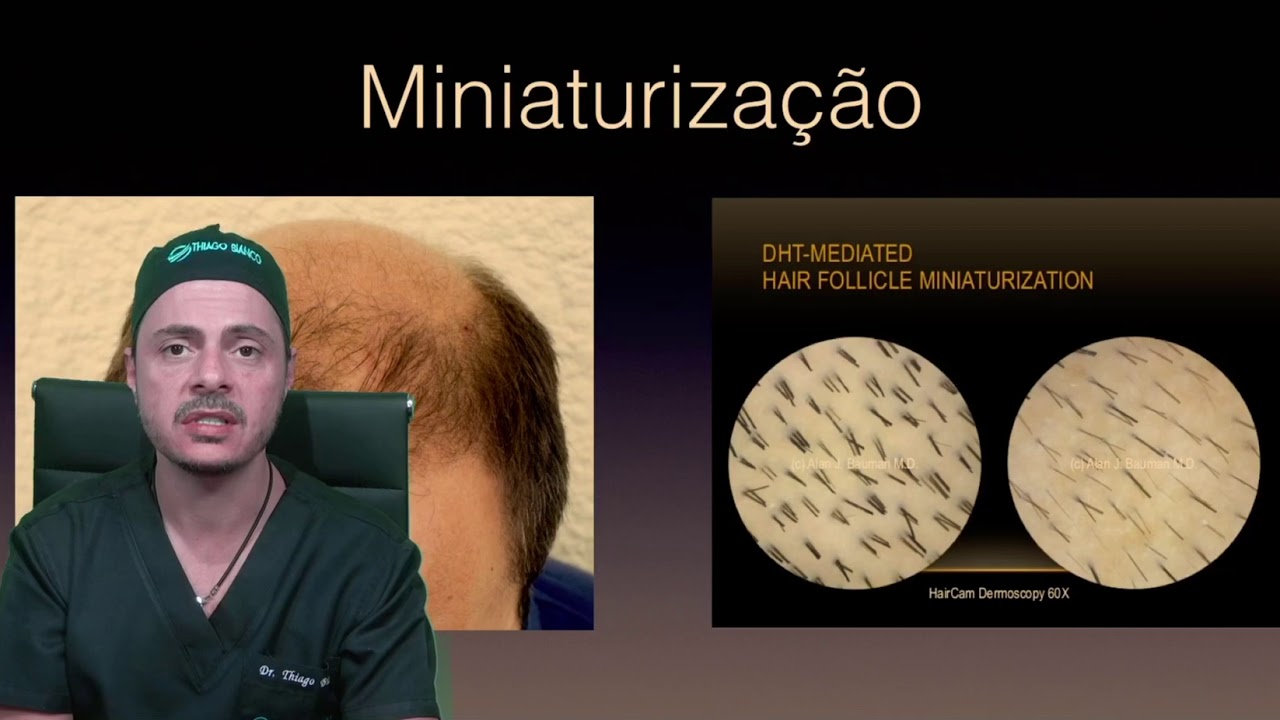 Precisa tomar finasterida após o transplante capilar?  - Dr. Thiago Bianco