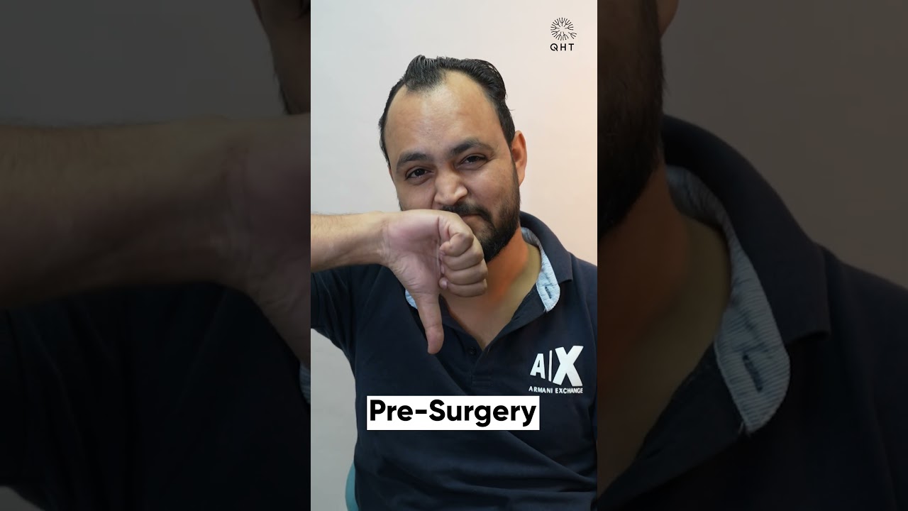 Hair Transplant Surgery Experience | Latest Fue Technique #shorts #viral #hair transplant