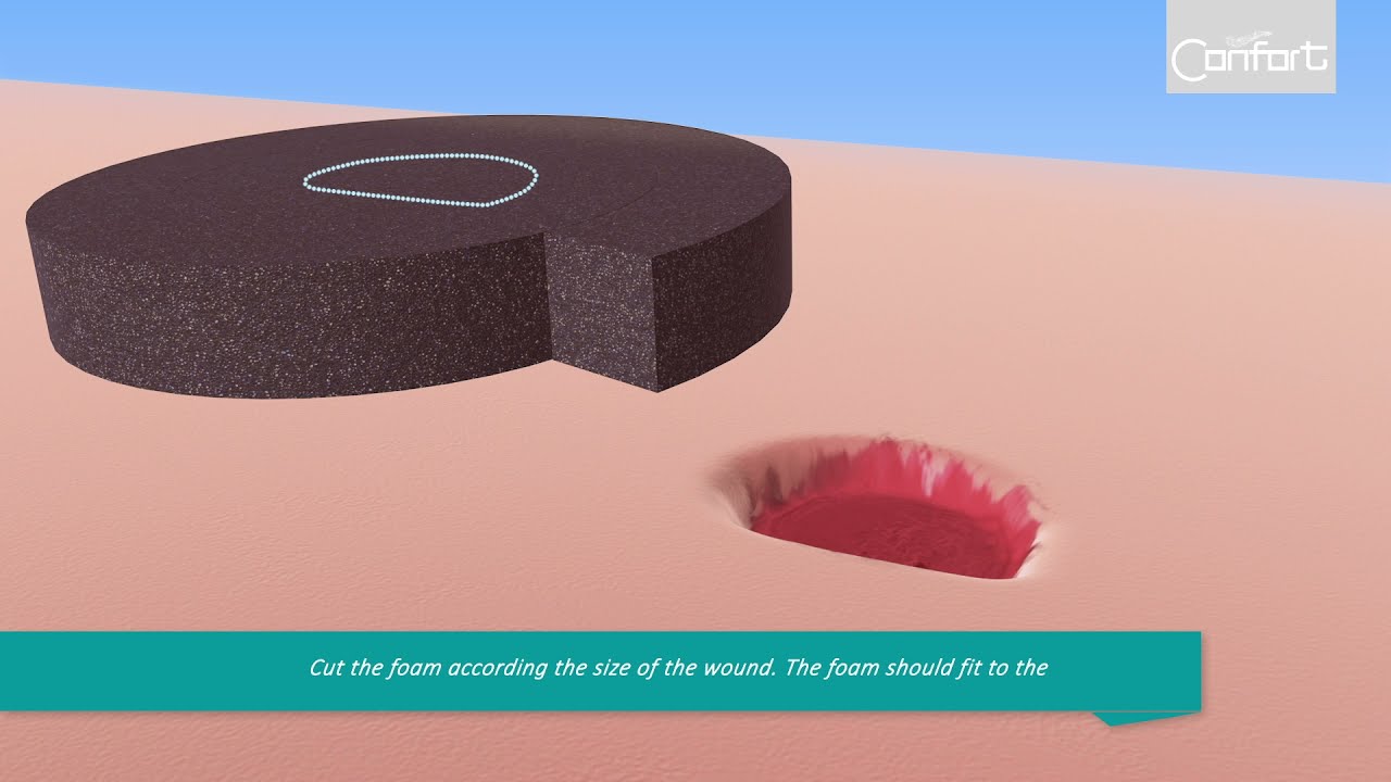 APPLICATION OF CONFORT NPWT INSTILLATION THERAPY SETS