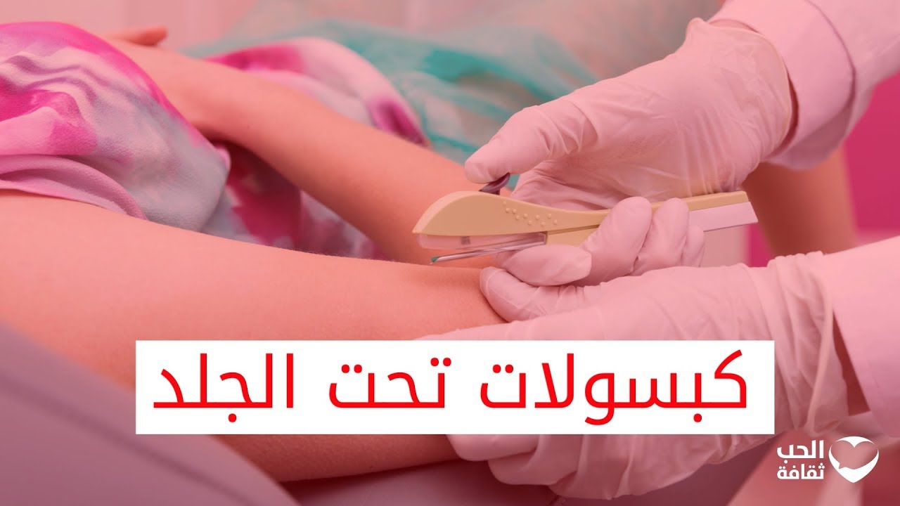 كبسولات تحت الجلد ومنع الحمل. تعرفوا عليها في هذا الفيديو.