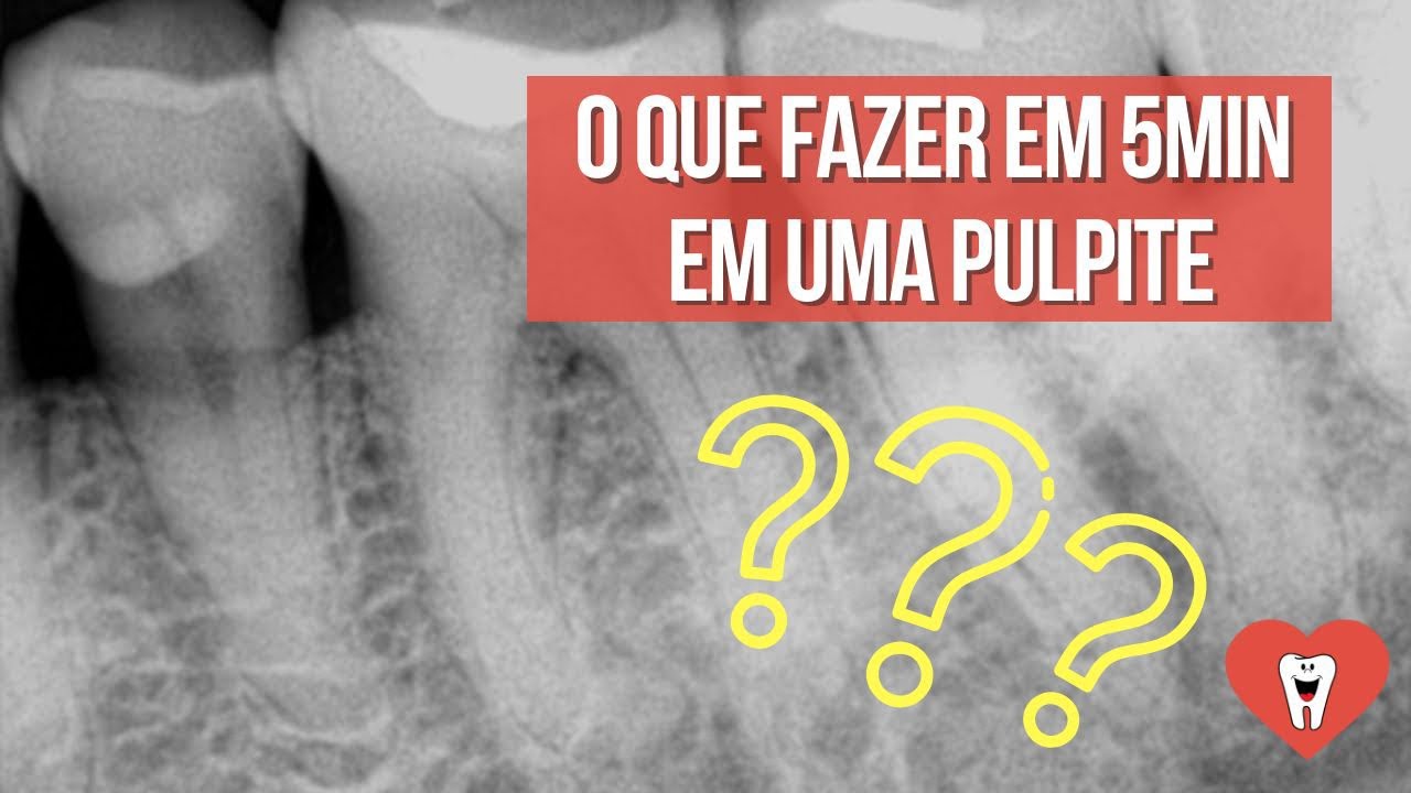 COMO AJUDAR UM PACIENTE COM PULPITE EM 5 MINUTOS? - Endolovers