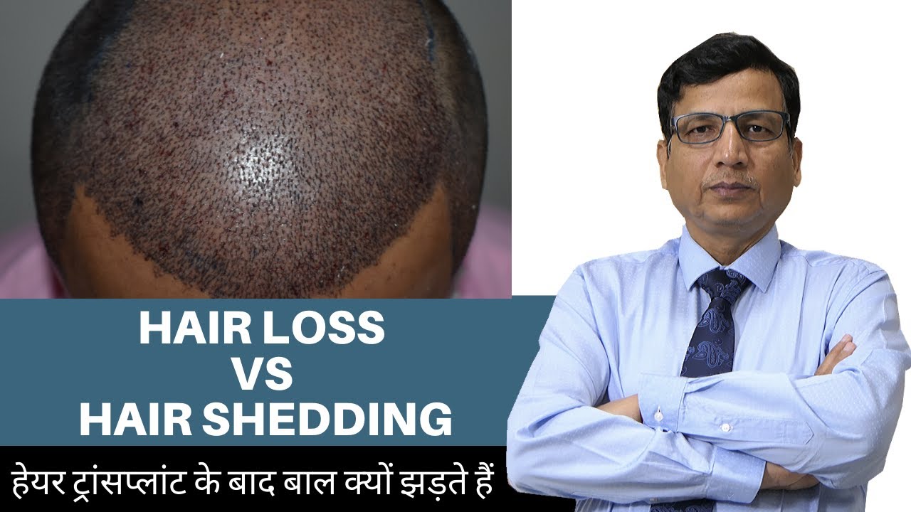 Why Hair Shedding Happens After Hair Transplant - (हेयर ट्रांसप्लांट के बाद बाल क्यों झड़ते हैं)