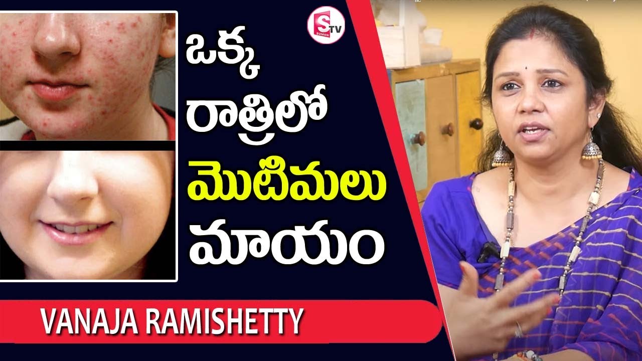 Vanaja Ramishetty - How To Remove Pimples Overnight || Acne Treatment || SumanTV Mom
