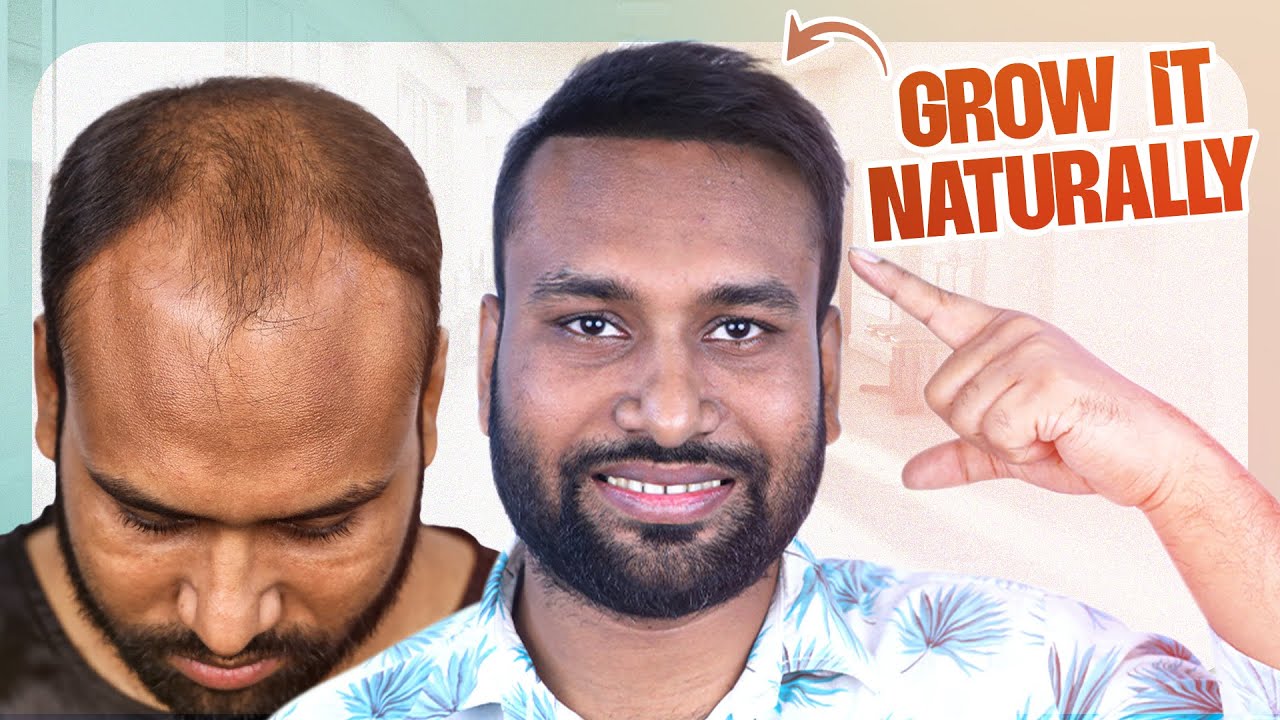 Hair Transplant Result Will Amaze You 😱 | Baldness Treatment in Bangladesh | New Roots