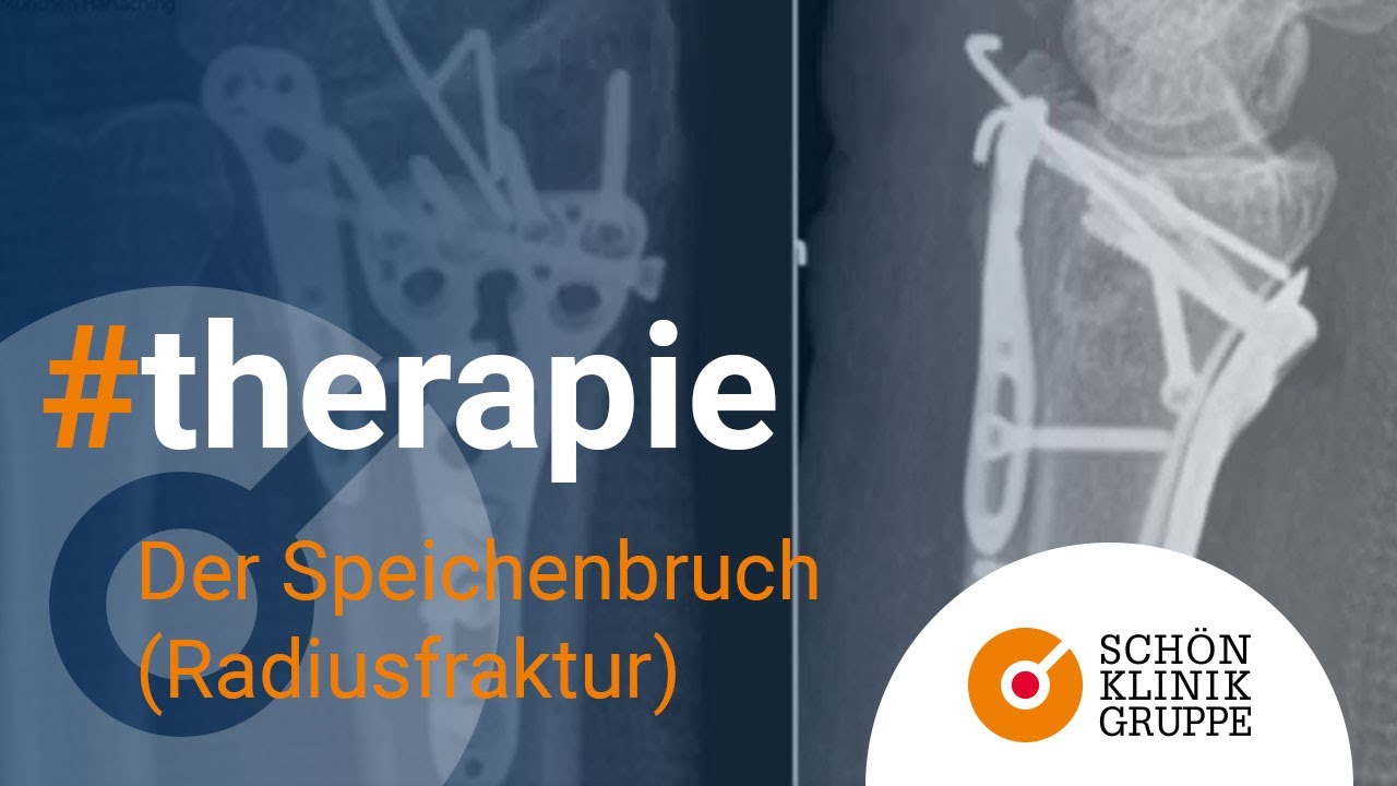 Der Speichenbruch (Radiusfraktur) | Schön Klinik München Harlaching