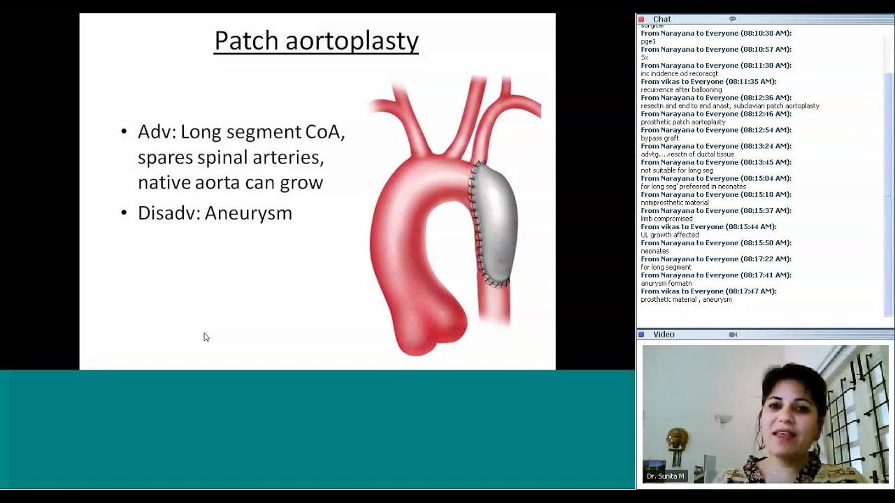 Quiz on Coarctation RX by Dr Sunita Maheshwari