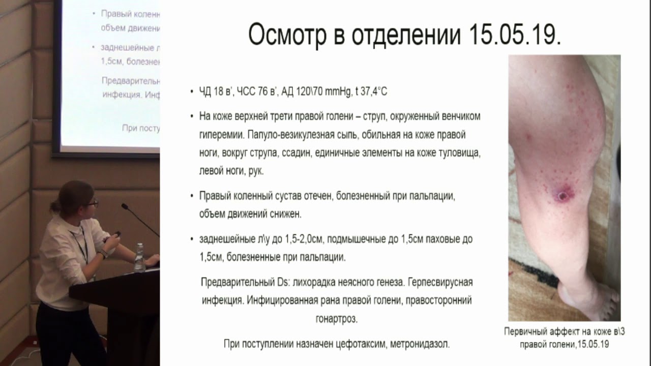Перекопская Н.Е. «Клинический случай клещевого риккетсиоза»