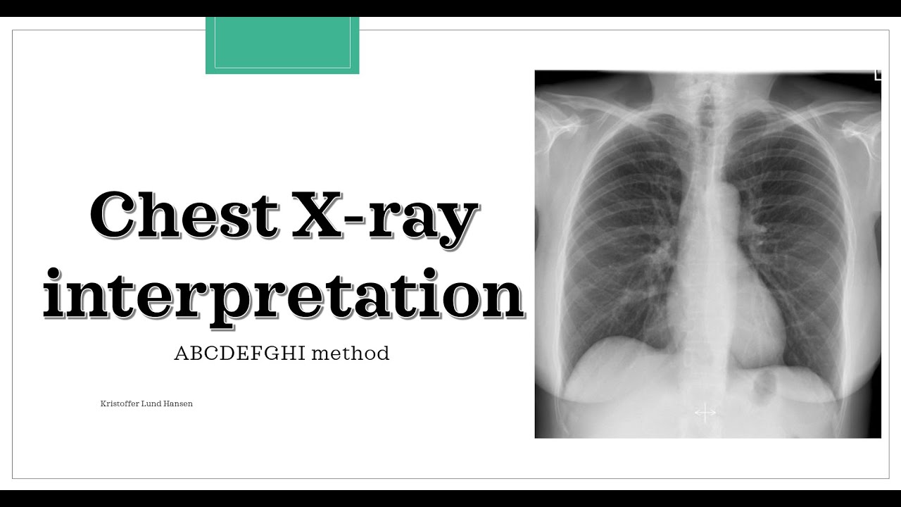 Chest X-ray interpretation (ABCDEFGHI method)