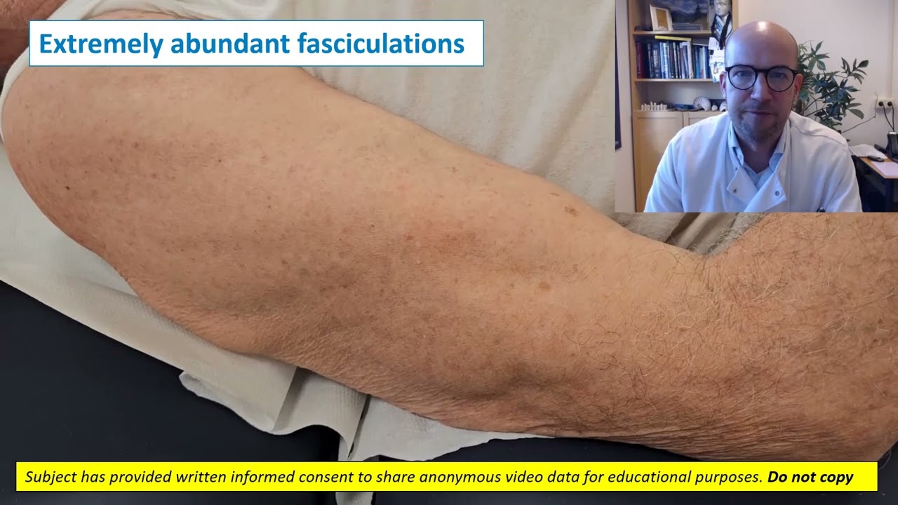 Needle EMG: fasciculations