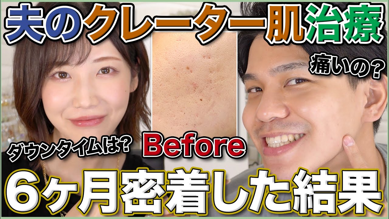 【6ヶ月密着】クレーター肌治療の経過を全て見せます。
